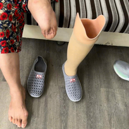 Hoàn thiện chân giả dưới gối cho cô khách ở Hà Tĩnh