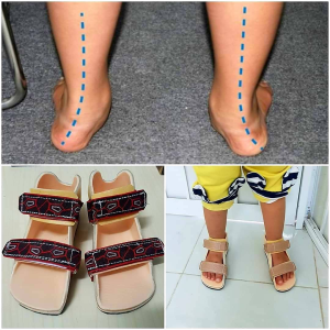 Nẹp nắn chỉnh bàn chân bẹt