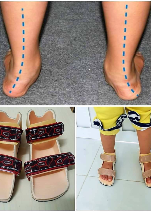 Nẹp nắn chỉnh bàn chân bẹt