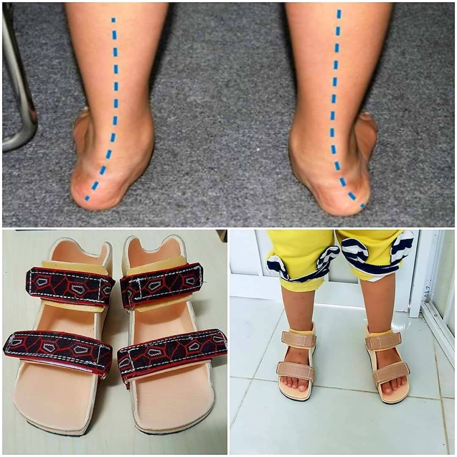 Nẹp nắn chỉnh bàn chân bẹt